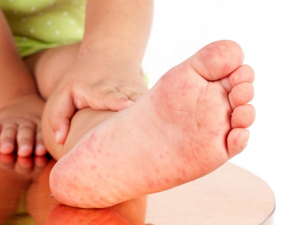trẻ bị nổi mẩn đỏ ở chân và tay