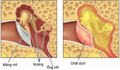 bệnh viêm tai giữa thanh dịch