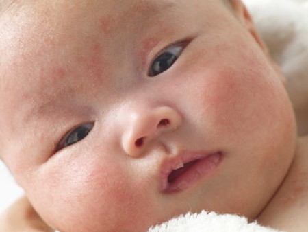 trẻ bị nổi mẩn đỏ như muỗi đốt