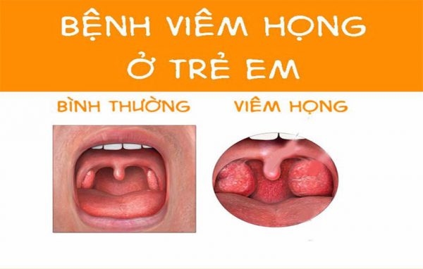 viêm họng ở trẻ nhỏ