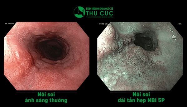 Công nghệ nội soi dải tần ánh sáng hẹp NBI 5P cho phép quan sát chi tiết các mô dưới lớp niêm mạc, phát hiện ung thư ở giai đoạn rất sớm