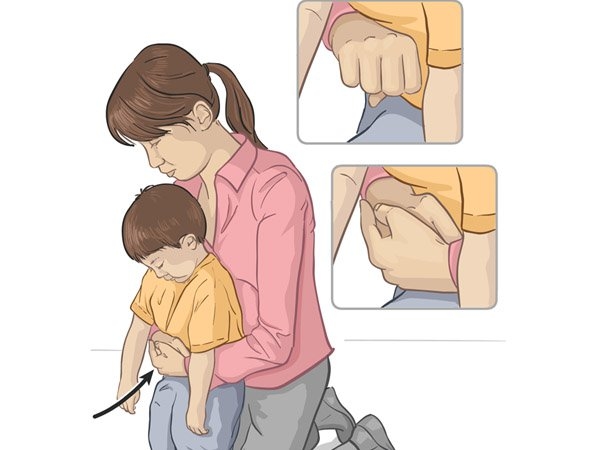 Phương pháp Heimlich