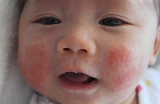 Bệnh chàm ở trẻ em: Hiểu đúng nguyên nhân
