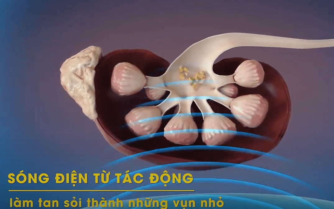 Dịch vụ tán sỏi ngoài cơ thể tại bệnh viện Thu Cúc