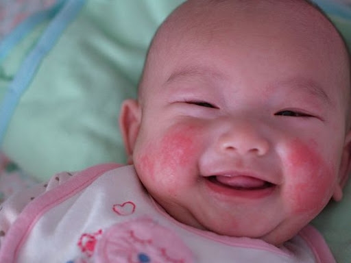những bệnh lý thường gặp ở trẻ sơ sinh