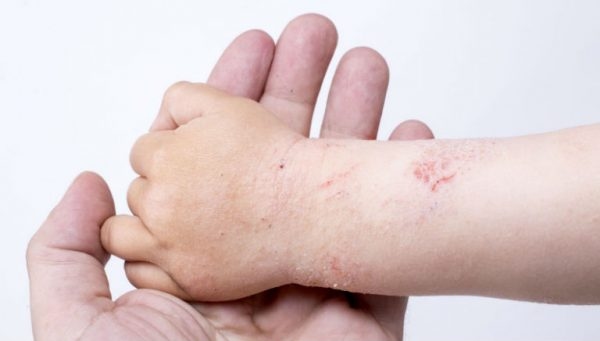 các dạng viêm da dị ứng ở trẻ em