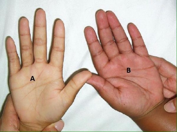 Lòng bàn tay nhợt nhạt là dấu hiệu của bệnh thiếu máu ở trẻ em. 