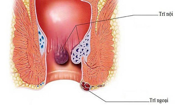 Điều trị trĩ phải ‘đi từ gốc’ ít xâm lấn là giải pháp tối ưu