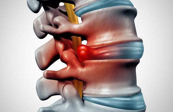 Chụp MRI có ưu thế hơn trong chẩn đoán thoát vị đĩa đệm
