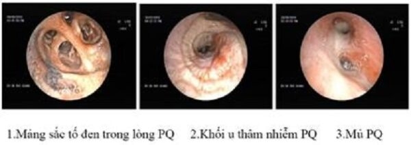 Hình ảnh nội soi phế quản ống mềm