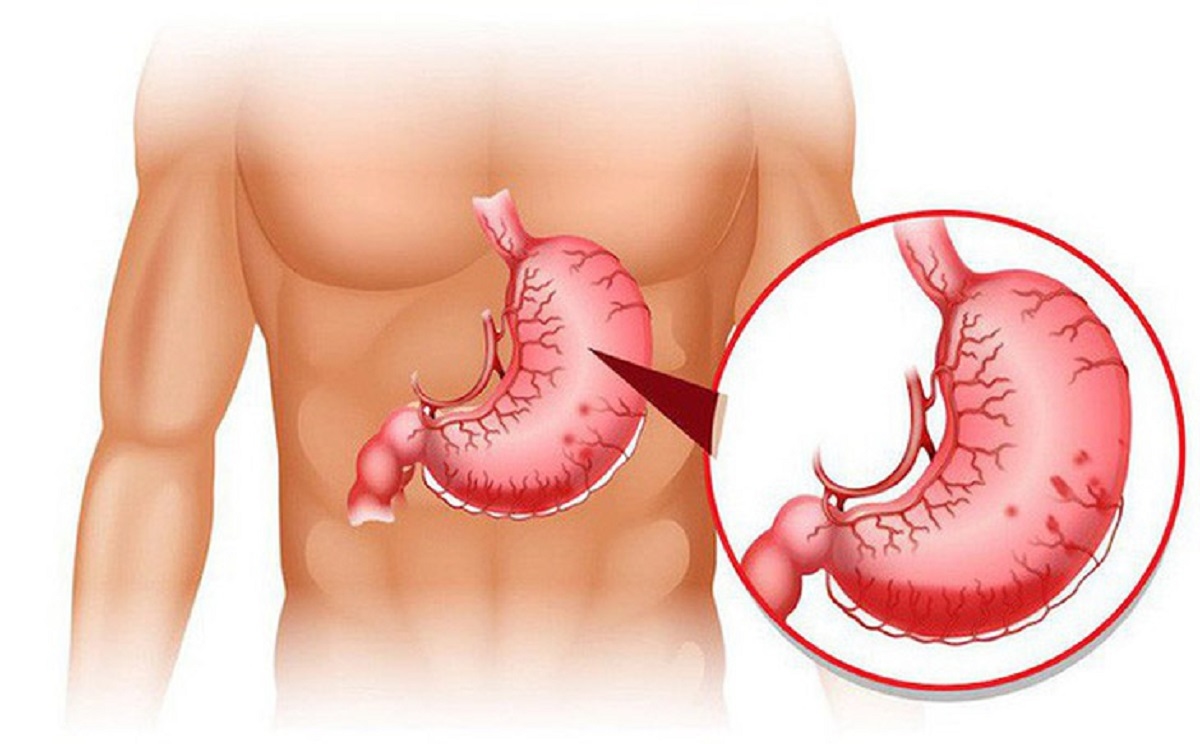 Bệnh dạ dày &#8211; quả bom nổ chậm cần tháo ngòi nổ kịp thời