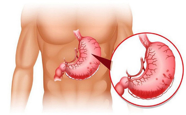 Bệnh dạ dày &#8211; quả bom nổ chậm cần tháo ngòi nổ kịp thời
