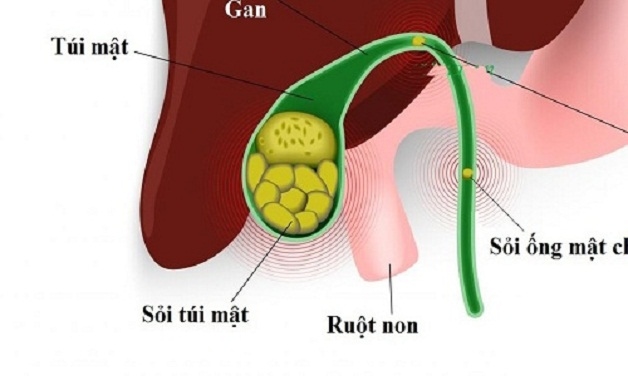 Nếu không phát hiện và chữa trị sỏi mật đúng cách có nguy cơ xảy ra nhiều biến chứng nguy hiểm.