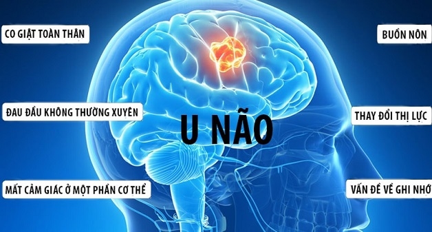 50% bệnh nhân u não có hiện tượng đau đầu kinh niên