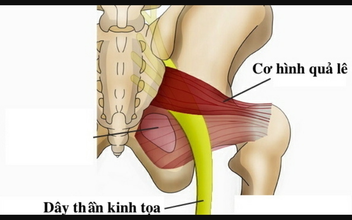 Đau dây thần kinh tọa &#8211; nguyên nhân, triệu chứng
