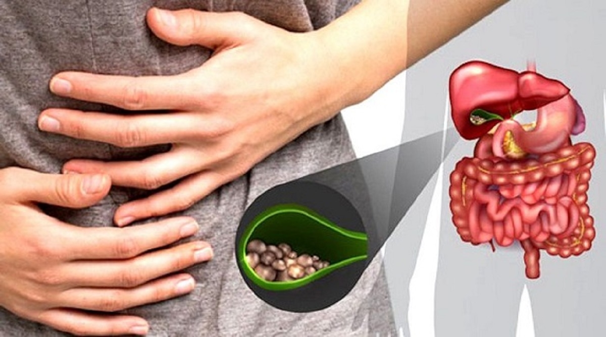 Các phương pháp điều trị sỏi mật tối ưu nhất hiện nay