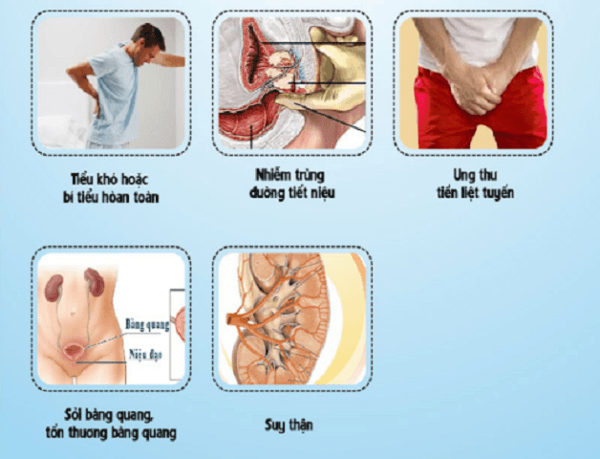 Những biến chứng nguy hiểm sẽ gặp nếu không điều trị u xơ tuyến tiền liệt kịp thời