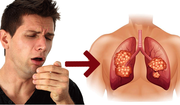 Gói tầm soát ung thư phổi có tốt không