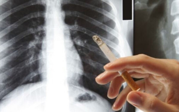 Gói tầm soát ung thư phổi là gì