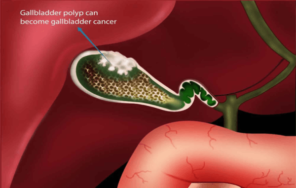 Hình minh hoạ ung thư hoá polyp túi mật