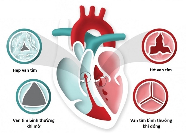 Hở van tim đang là một căn bệnh phổ biến hiện nay, hãy tự trang bị thêm kiến thức cho bản thân để có một trái tim khỏe mạnh.