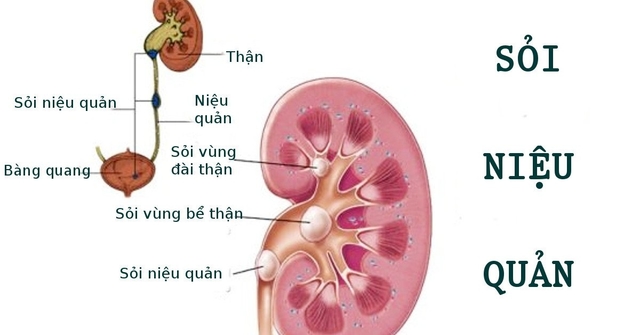 Nội soi sau phúc mạc lấy sỏi niệu quản chỉ định cho trường hợp nào?