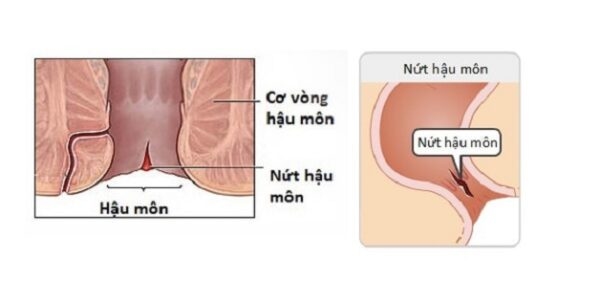 nứt kẽ hậu môn ở trẻ em là gì