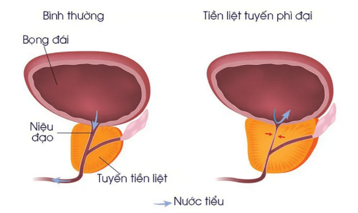 Phẫu thuật u xơ tuyến tiền liệt &#8211; chấm dứt &#8220;nỗi đau khổ&#8221; cho quý ông