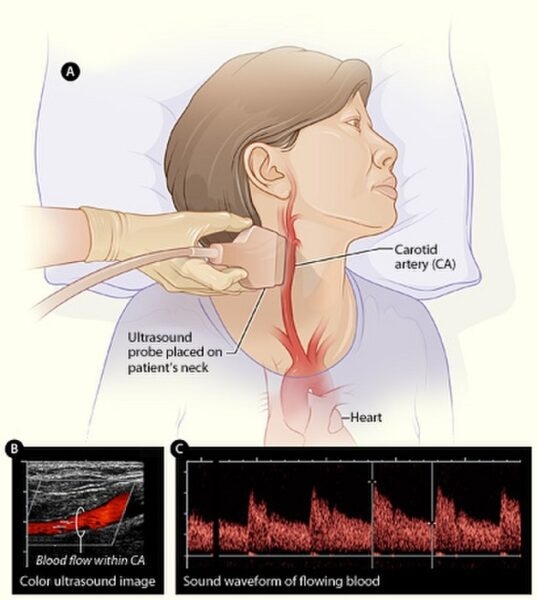 Siêu âm vùng cổ kiểm tra mạch máu