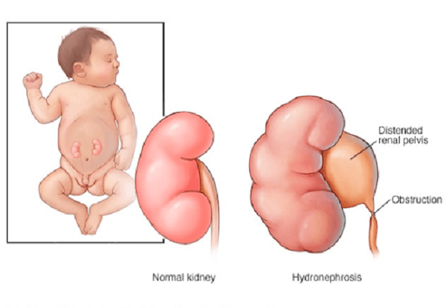Tạo hình khúc nối bể thận niệu quản có 2 phương pháp