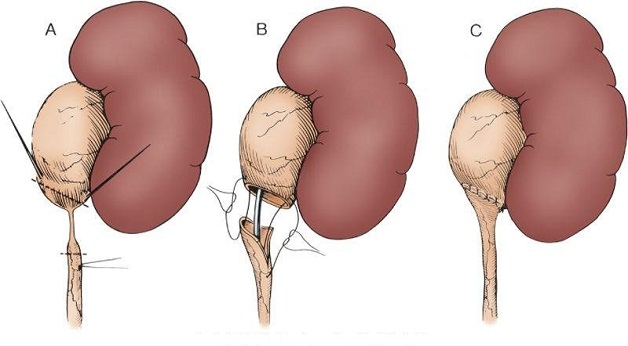 Phẫu thuật tạo hình khúc nối bể thận niệu quản có tỷ lệ thành công cao