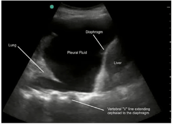 Hình ảnh tràn dịch màng phổi trên siêu âm phổi - màng phổi. Vị trí Pleurual Fluid là vùng dịch trong màng phổi.
