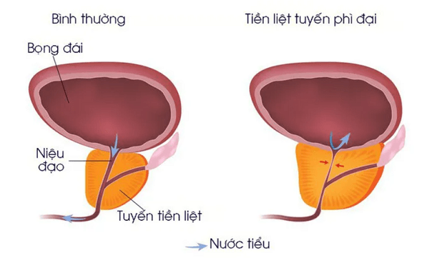 Khi bước sang độ tuổi 40, tuyến tiền liệt bắt đầu phát triển bất thường gây u xơ phì đại tuyến tiền liệt