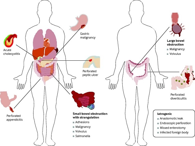 Viêm phúc mạc thứ phát