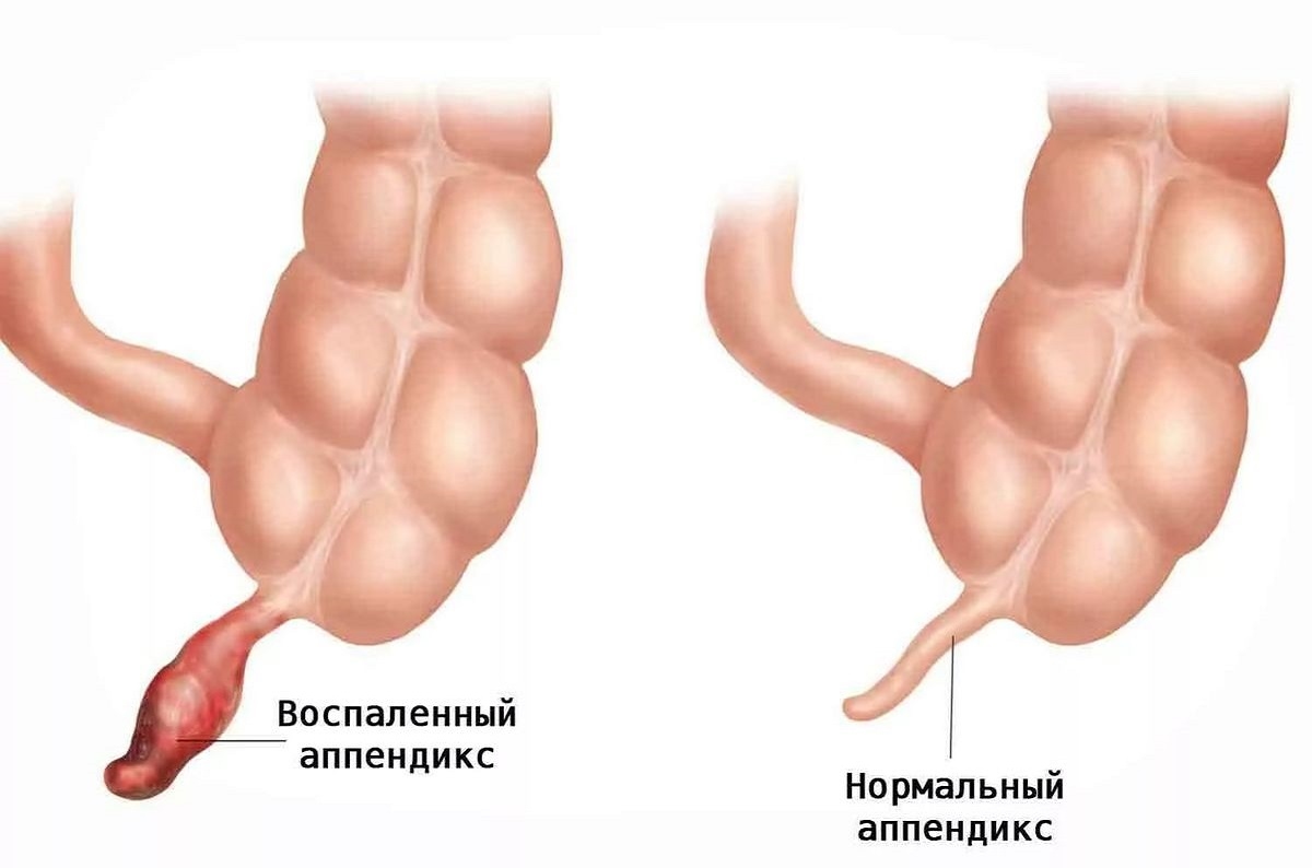 Viêm ruột thừa &#8211; nguyên nhân, dấu hiệu nhận biết và cách xử lý
