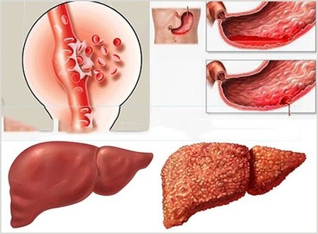 Nếu không được điều trị kịp thời xơ gan F4 để lại những biến chứng vô cùng nguy hiểm