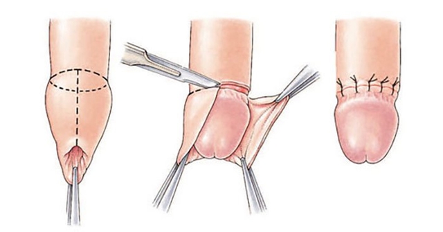 Giải đáp hết thắc mắc về phẫu thuật cắt bao quy đầu 