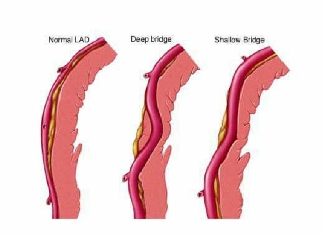 Cầu cơ mạch vành là một dị tật bẩm sinh hiếm gặp, lành tính