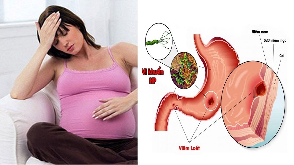 Đau dạ dày khi mang thai nguy hiểm hơn những gì mẹ nghĩ  