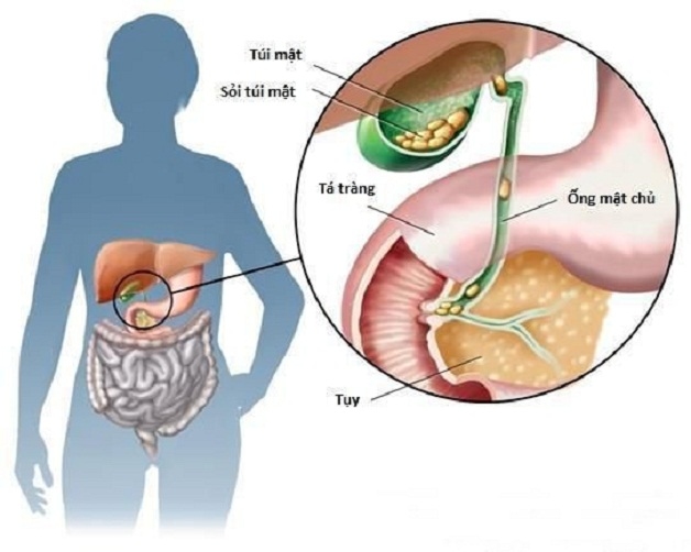  Sỏi mật có thể xuất hiện ở nhiều vị trí khác nhau trong hệ dẫn mật