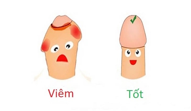Bao quy đầu bị sưng đỏ là một trong dấu hiệu dễ nhận biết nhất của bệnh này