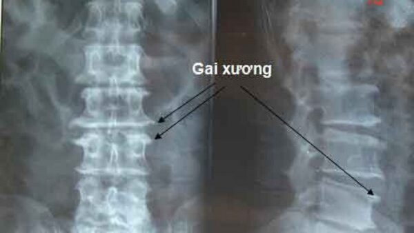 phát hiện gai xương đốt sống cổ
