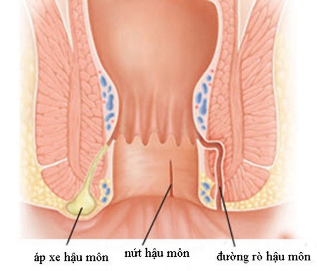 Một số bệnh lý vùng hậu môn - trực tràng