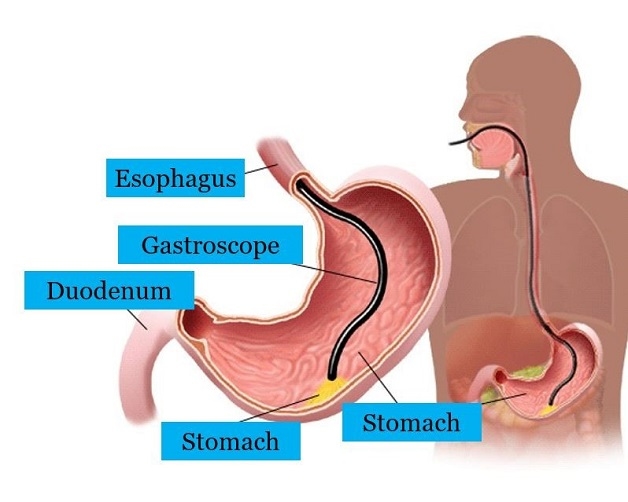 điều cần chú ý trước khi nội soi dạ dày là gì