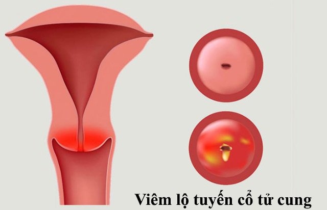 Khí hư có mùi chua có thể do bạn bị viêm lộ tuyến cổ tử cung
