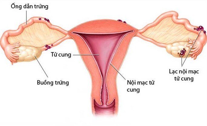 Phụ nữ mắc bệnh lạc nội mạc tử cung sẽ có kỳ kinh dài hơn hơn, mất nhiều máu hơn và đau bụng nhiều hơn.