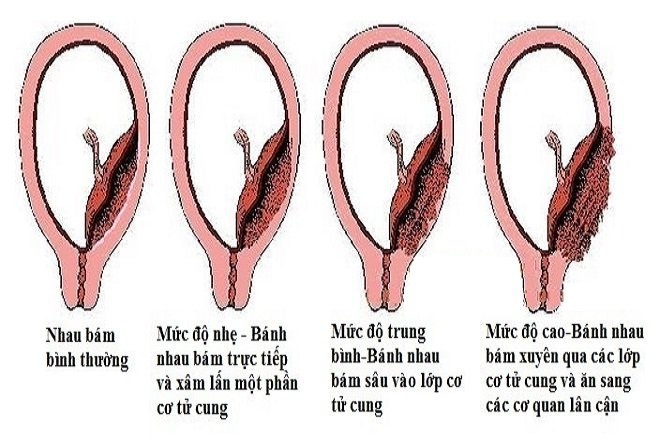 Nhau cài răng lược được chia thành 3 thể chính, dựa vào mức độ xâm lấn của bánh nhau