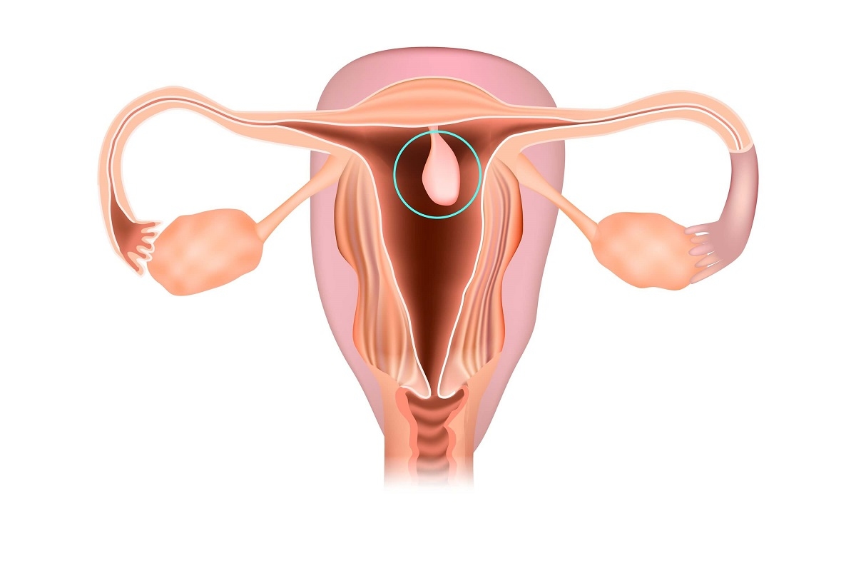 Polyp cổ tử cung: Tìm hiểu triệu chứng, nguyên nhân