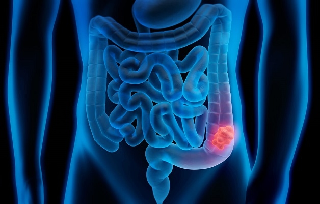 Polyp đại tràng cần được phát hiện sớm