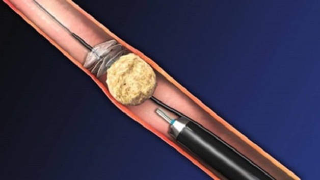 Tán sỏi laser ngược dòng là kỹ thuật tán sỏi theo đường 
